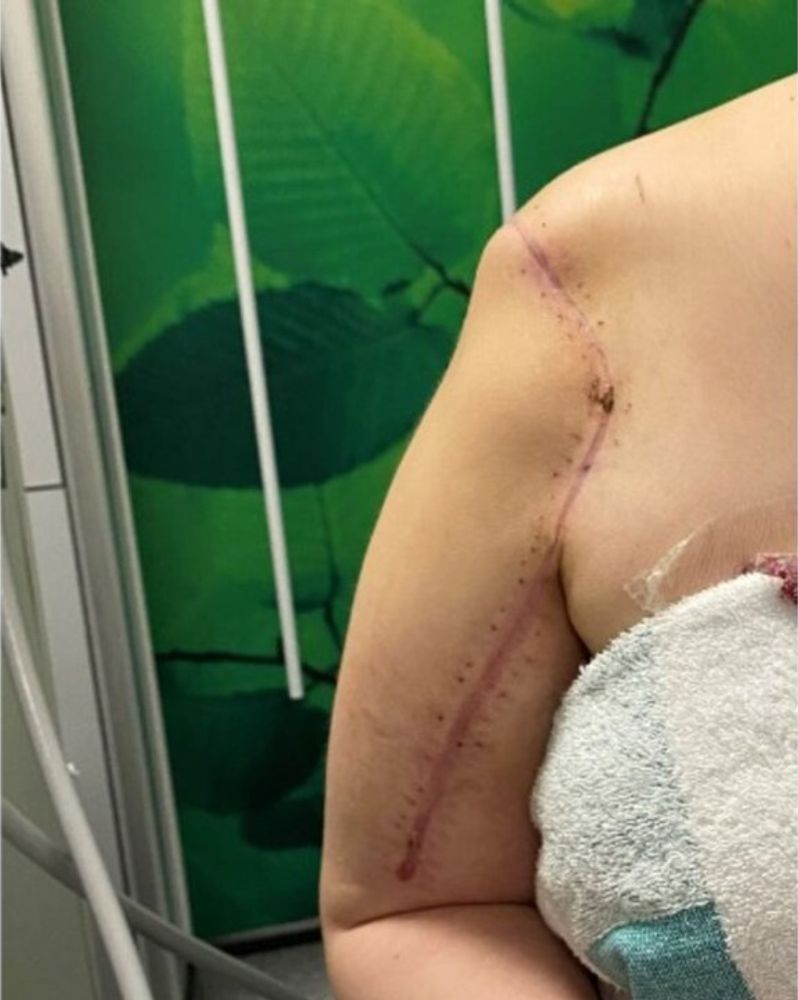 El tratamiento incluyó ciclos de quimioterapia y una cirugía mayor que dejó secuelas físicas en la adolescente.