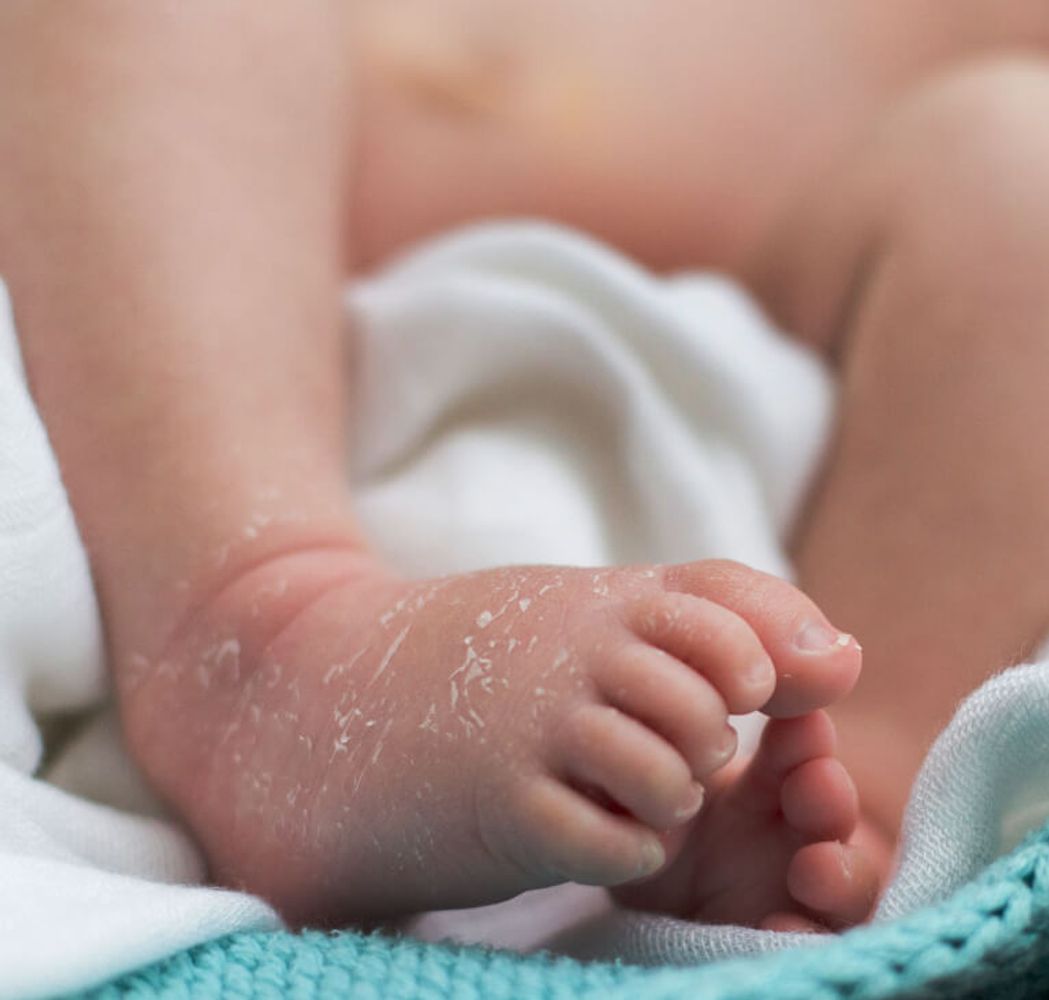 Pies de bebe irritado