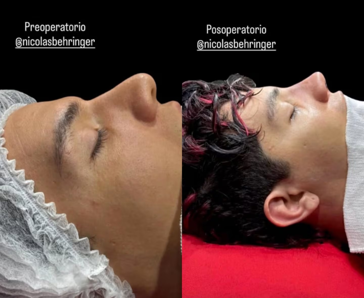 Nicolás Behringer mostró el antes y después de su operación.