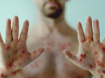 La sífilis avanza, pero se puede prevenir: concientizar para cuidar la salud