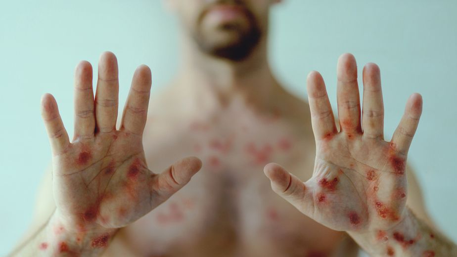 La sífilis avanza, pero se puede prevenir: concientizar para cuidar la salud