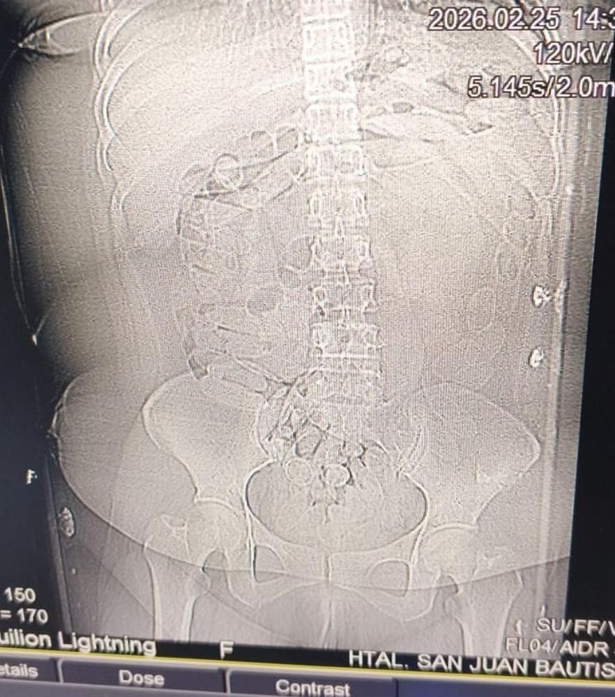 Una mujer de origen extranjero que viajaba desde Jujuy en un colectivo de larga distancia tenía noventa cápsulas con droga en el cuerpo.