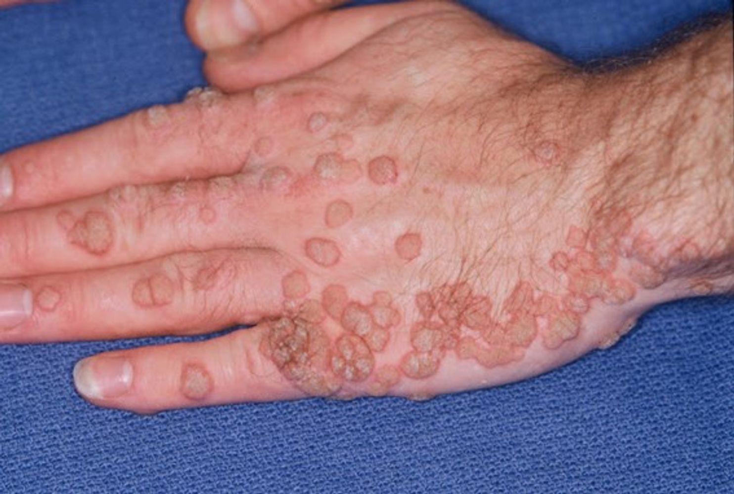 Virus del Papiloma Humano