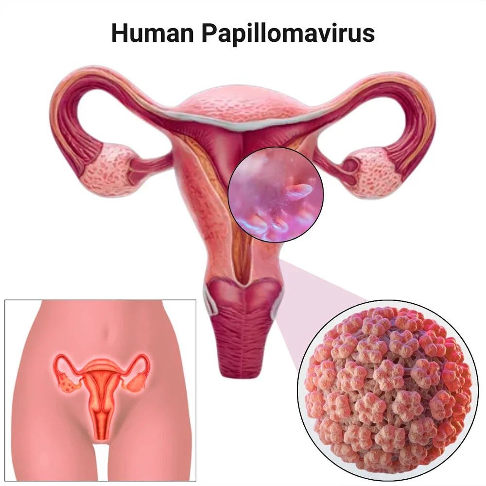 Virus del Papiloma Humano