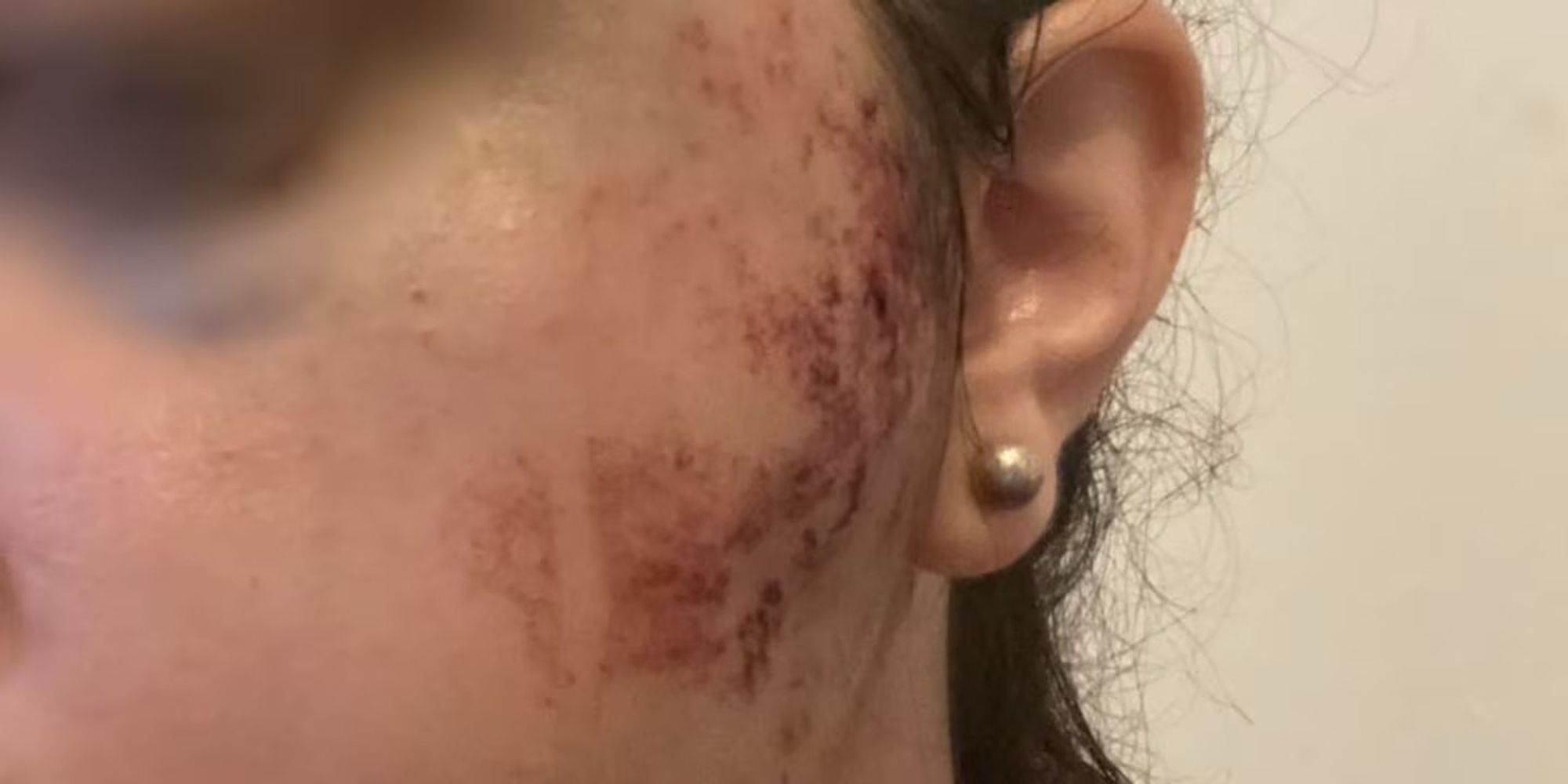 Las lesiones de Micaela.