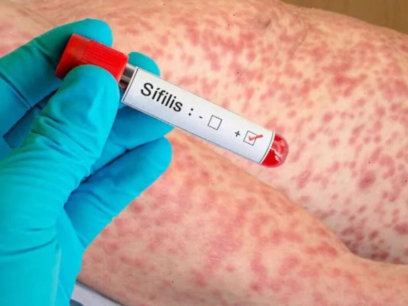 Alerta por el aumento de sífilis en embarazadas.