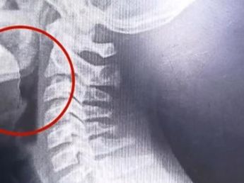 Un chico de 14 años comió una galletita de agua y escupió sangre: descubrieron algo inesperado en su garganta