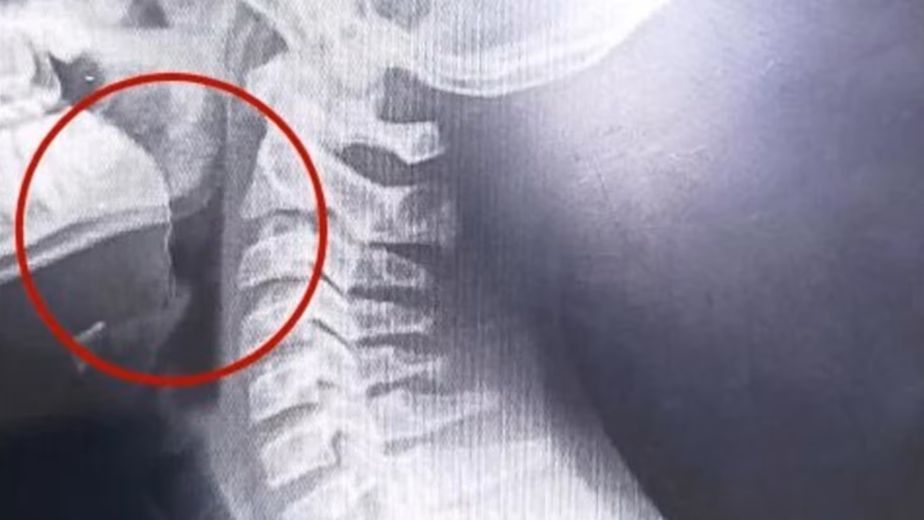 Un chico de 14 años comió una galletita de agua y escupió sangre: descubrieron algo inesperado en su garganta