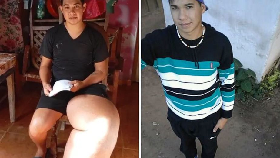 El impactante caso del joven de 28 años que busca una cirugía para frenar el crecimiento de su pierna