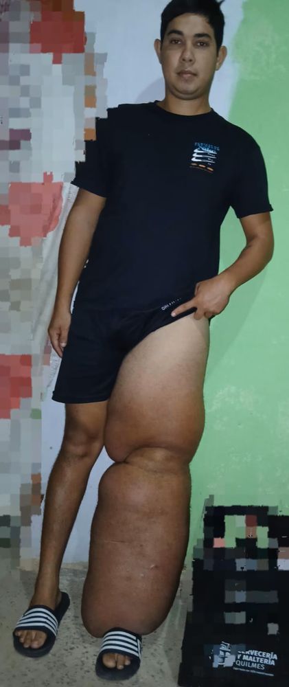 el joven correntino que tiene una rara enfermedad