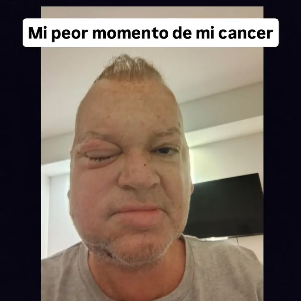 Leandro Rud y su lucha con el cáncer