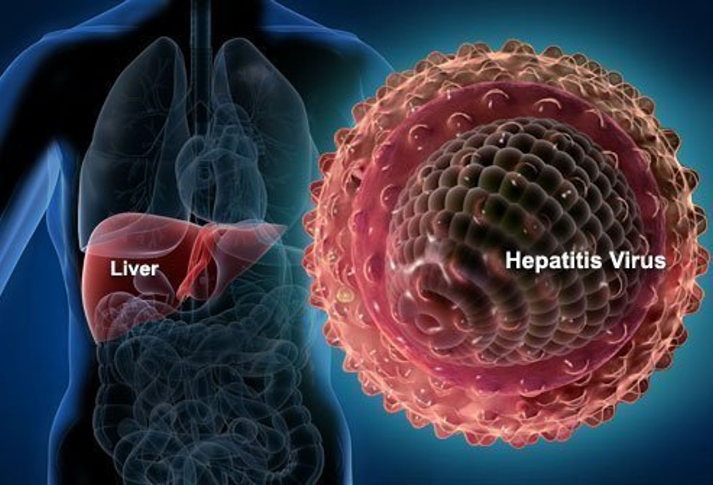 Hepatitis A.