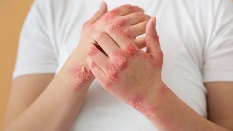 Crecen los casos de sífilis en jóvenes de Misiones y alertan por la baja percepción del riesgo sexual