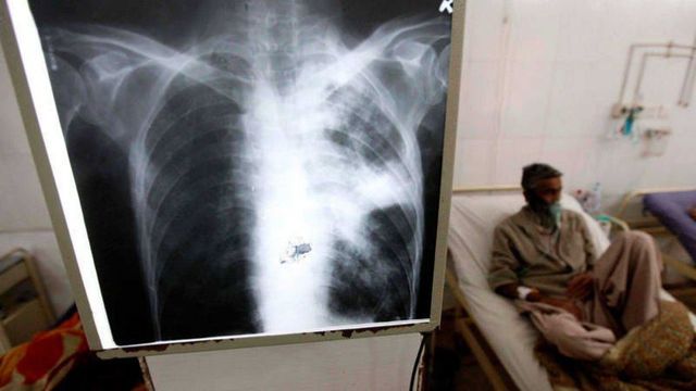 Tuberculosis. Foto ilustrativa, web.