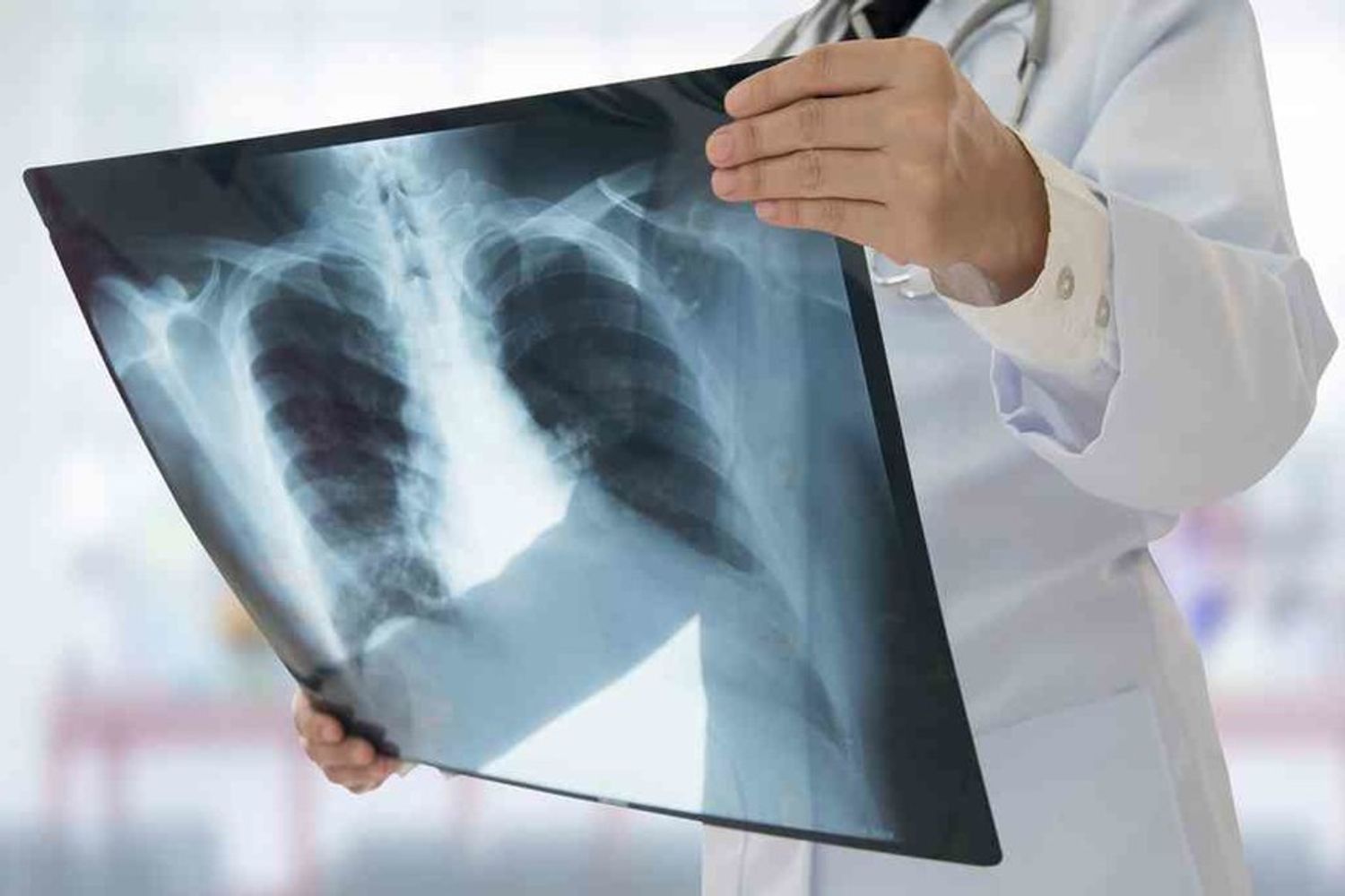 Tuberculosis.Fotos web.