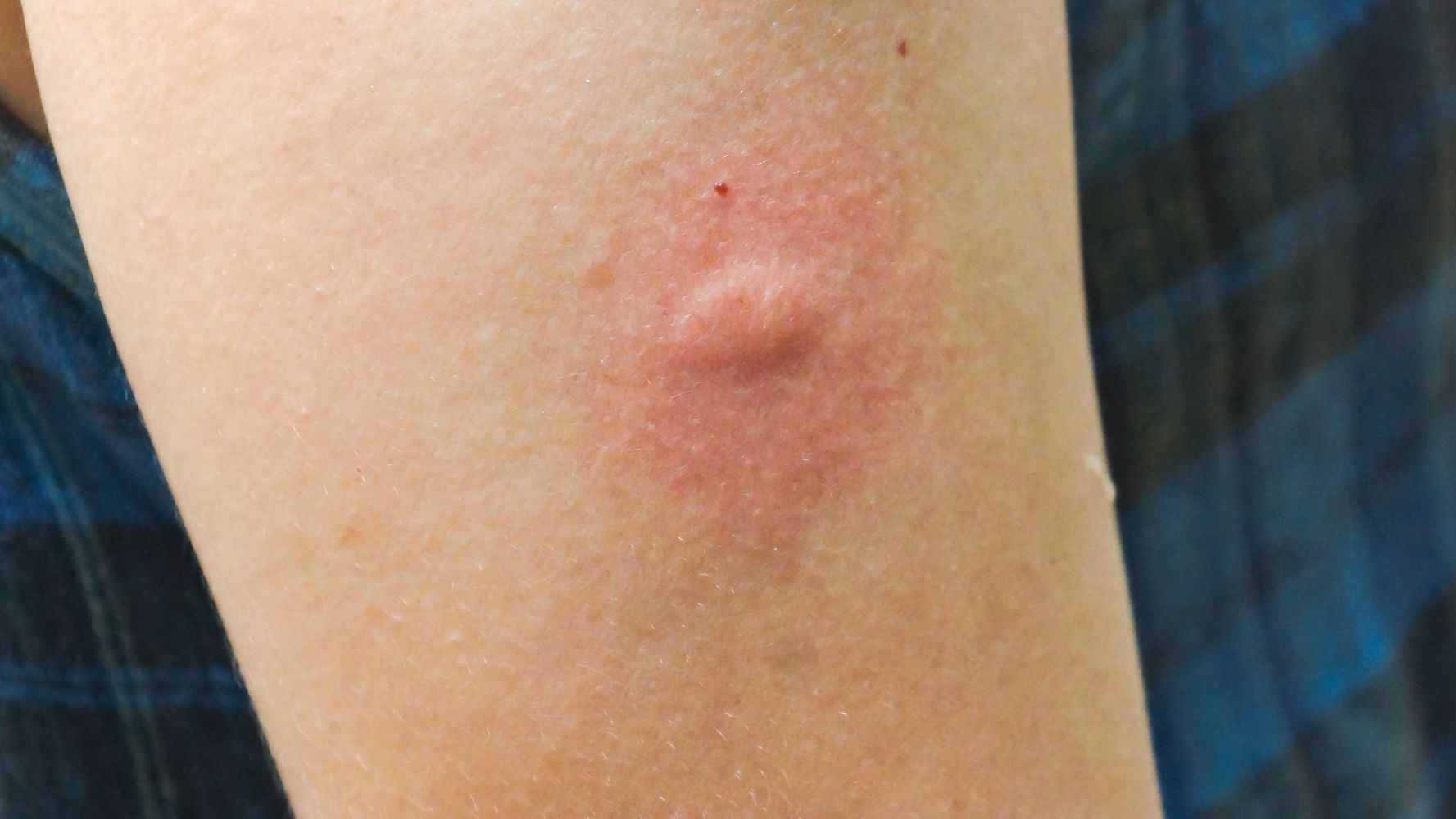 Es importante cuidarse de los mosquitos.