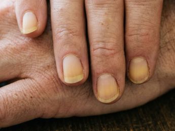 Uñas amarillas: por qué aparecen, cuáles son las señales de alerta y cuándo consultar a un dermatólogo
