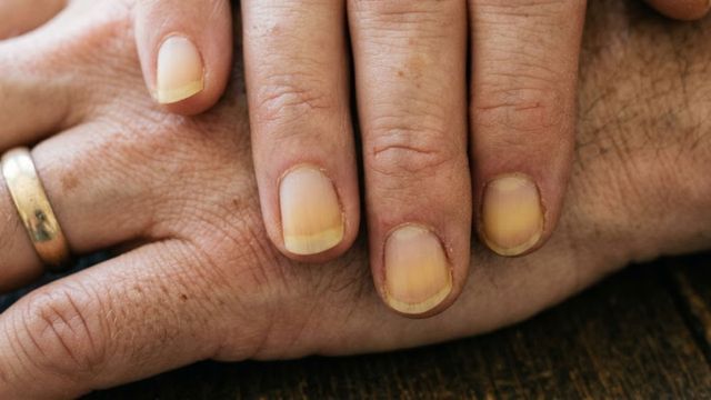 Las causas de las uñas amarillas.