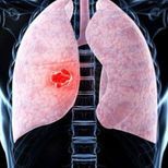 Qué es un nódulo pulmonar y cómo es la operación a la que se someterá el papa León XIV