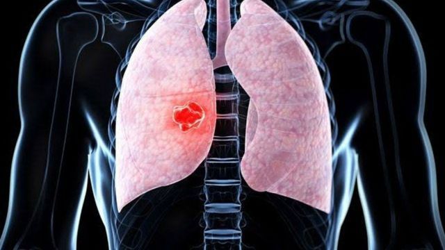 Qué es un nódulo pulmonar y cómo es la operación a la que se someterá el papa León XIV