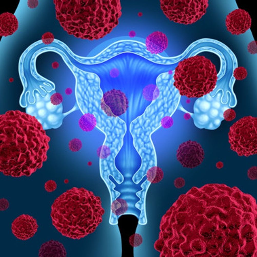 Cáncer de cuello uterino.  