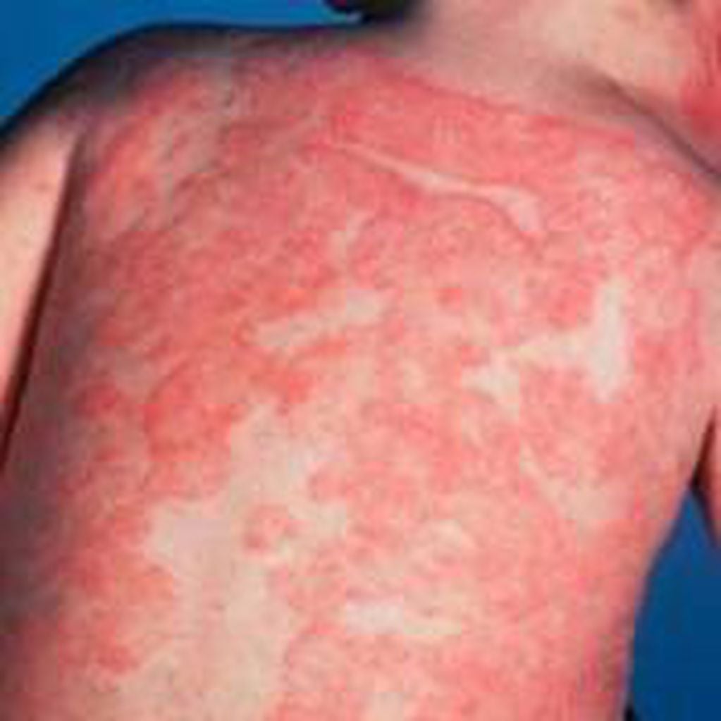 Dermatitis atópica crónica. (WEB)