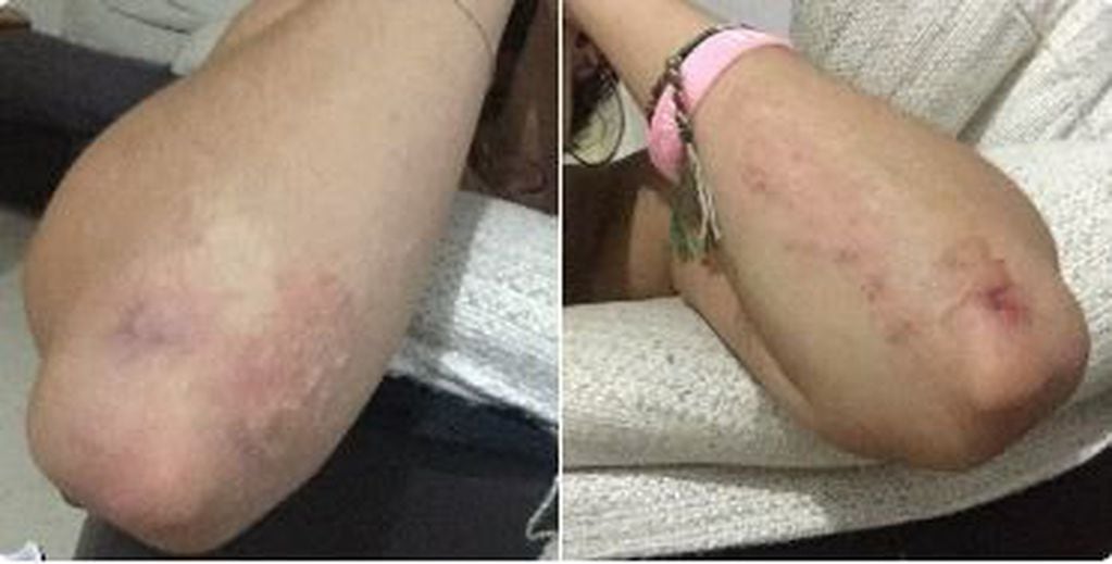 Una joven muestra cómo quedaron sus codos después de tirarse del tobogán de Estepona, España (Fuente: Twitter)