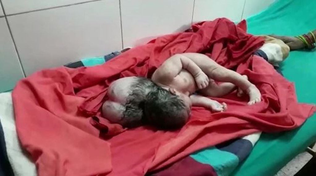 Nace en India una bebé con encefalocele y genera conmoción entre los médicos (Fotos: The Sun)