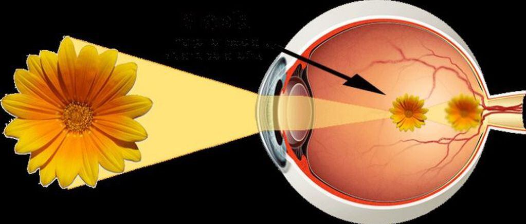 El sistema ocular en una miopía alta.