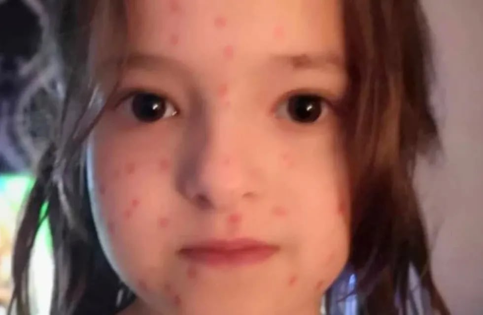 Lily Schooley, una niña inglesa de seis años, quiso evitar un examen y se pintó manchas rojas en la piel con marcador permanente