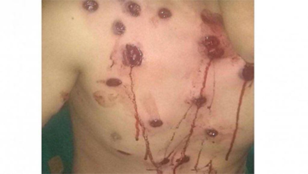 Denuncian violencia policial en Zapala: un joven recibió 15 balazos de goma