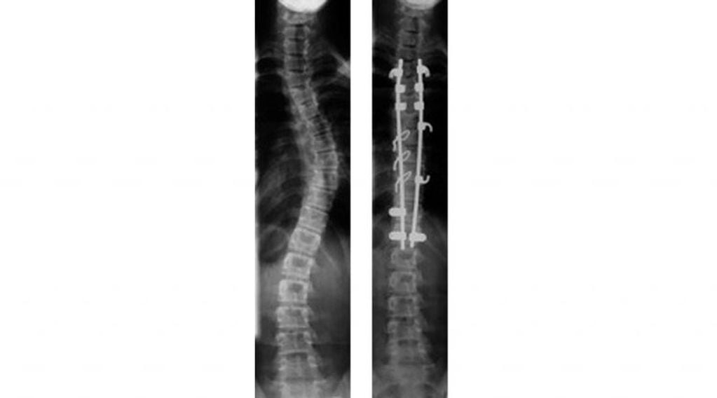 Radiografías del antes y después de una intervención quirúrgica similar, a modo de ilustración (Fontecha)