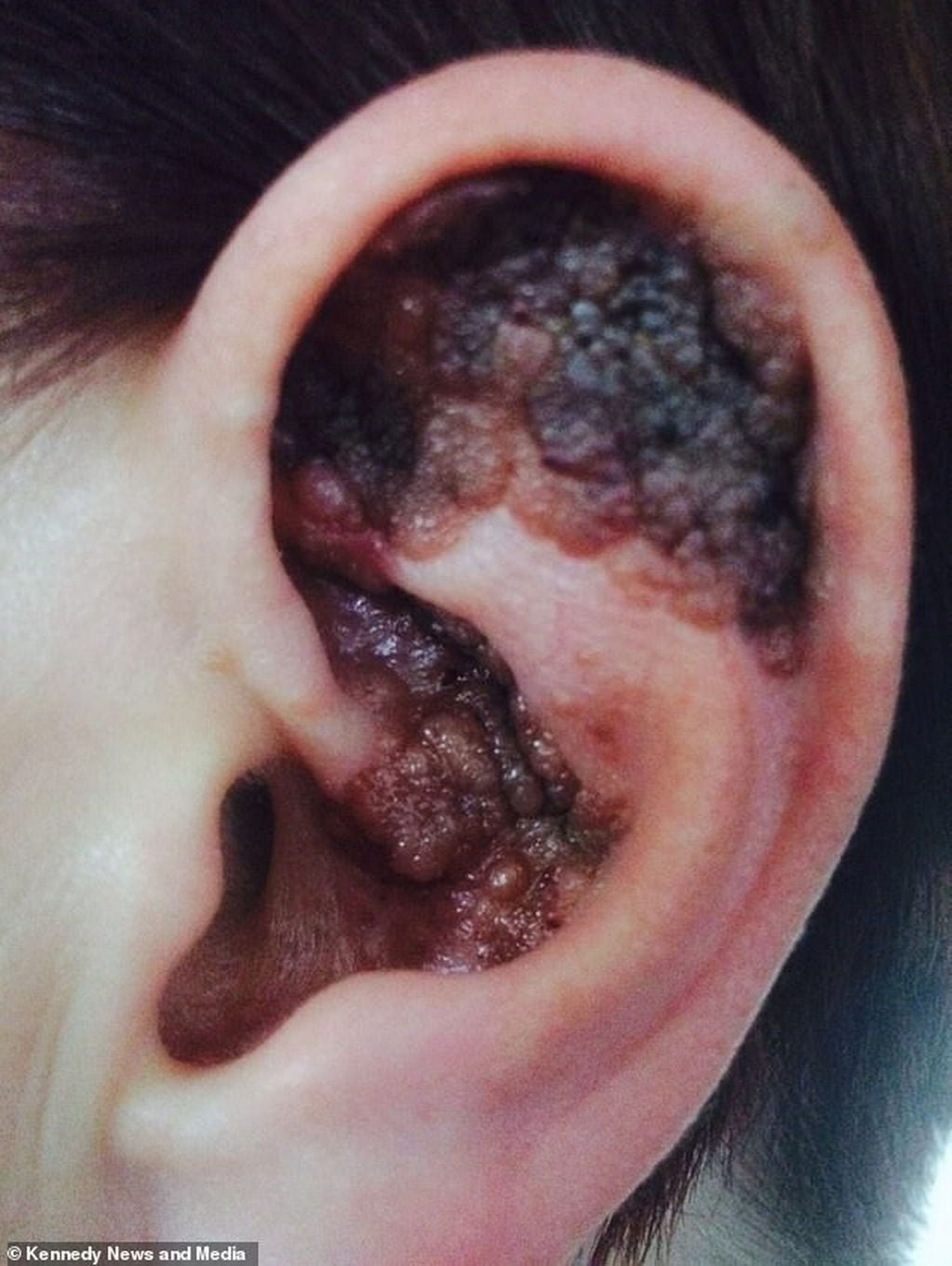 Así tenía la oreja Smith antes de que le detectaran melanoma.