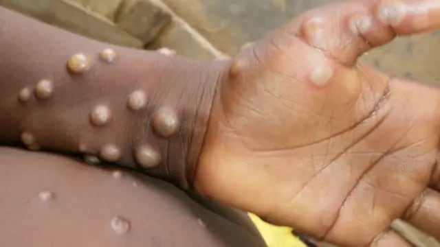 Lesiones cutáneas que produce la viruela del mono.