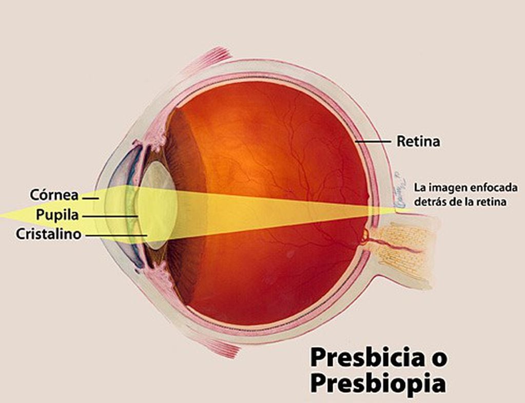 La presbicia es la pérdida progresiva de la capacidad ocular para enfocar objetos cercanos.