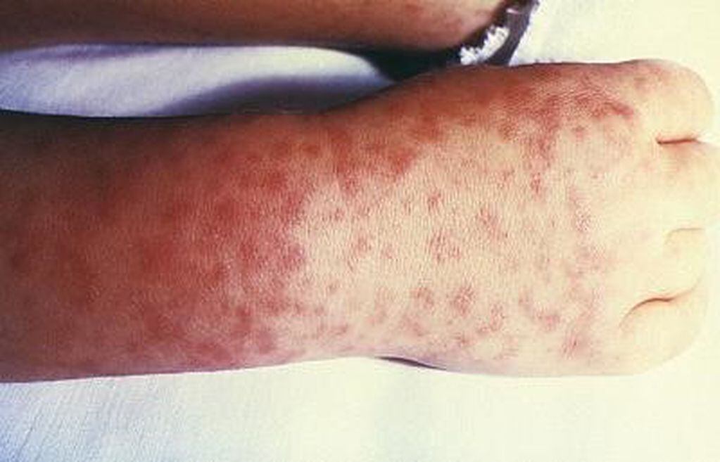 Uno de los síntomas de la Rickettsia son las manchas en la piel. (Web)