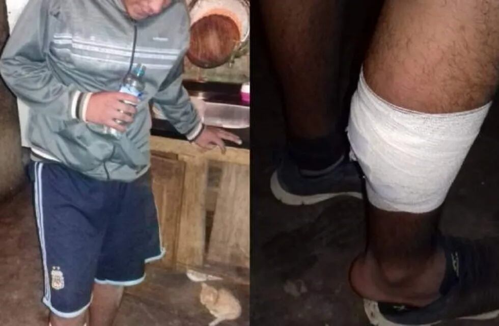 Así quedó la pierna de Ricardo Banegas, el sanjuanino que recibió el disparo.