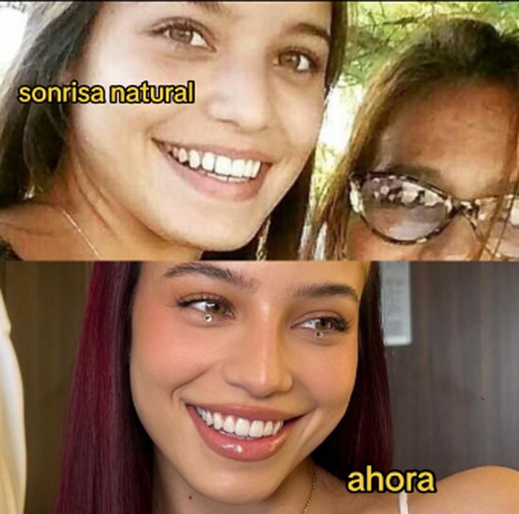 El antes y después en la sonrisa de Emilia Mernes