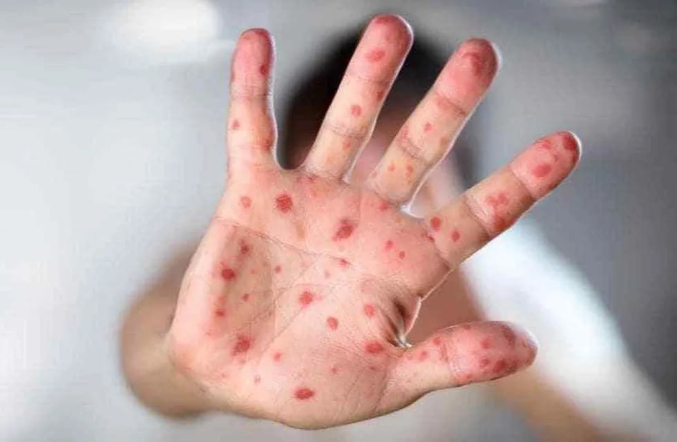El sarampión es una de las enfermedades de las que alerta el Ministerio de Salud de la Nación.