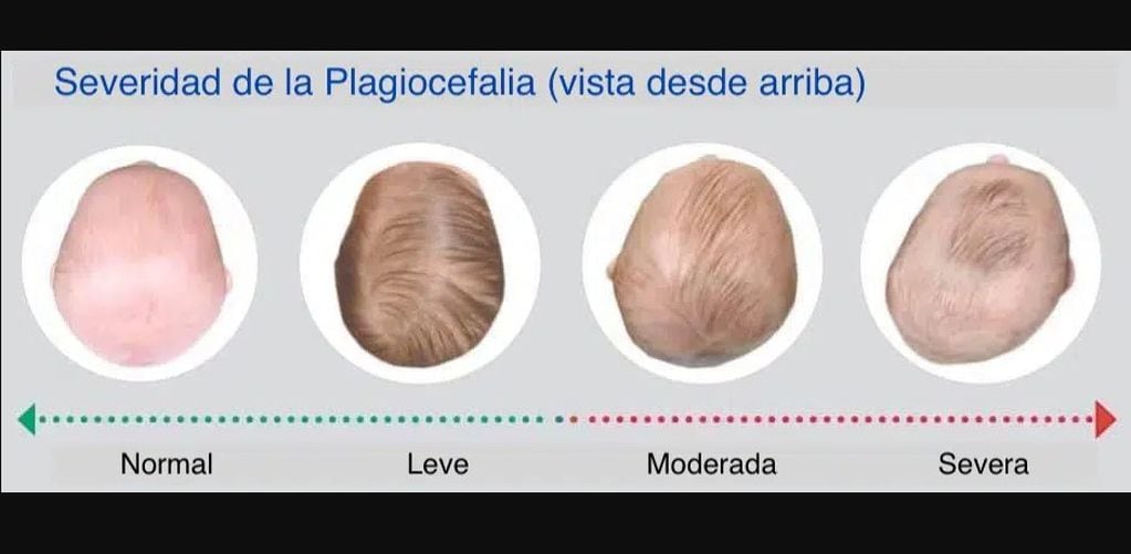 Plagiocefalia, severidad (imagen ilustrativa).
