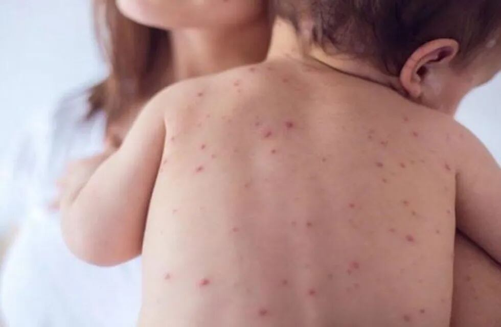Alertan sobre un brote de sarampión: recomiendan la vacunación