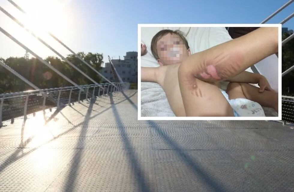 Niño quemado en el nuevo puente petaonal