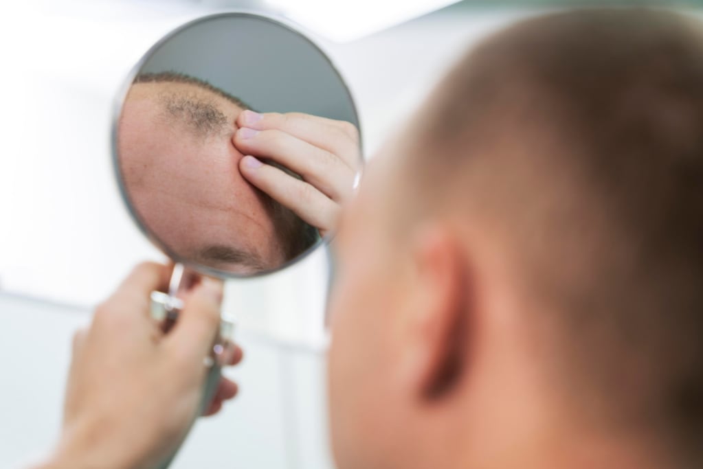 La alopecía areata a diferencia de la calvicie común, no está relacionada con el estrés, sino con un padecimiento genético.