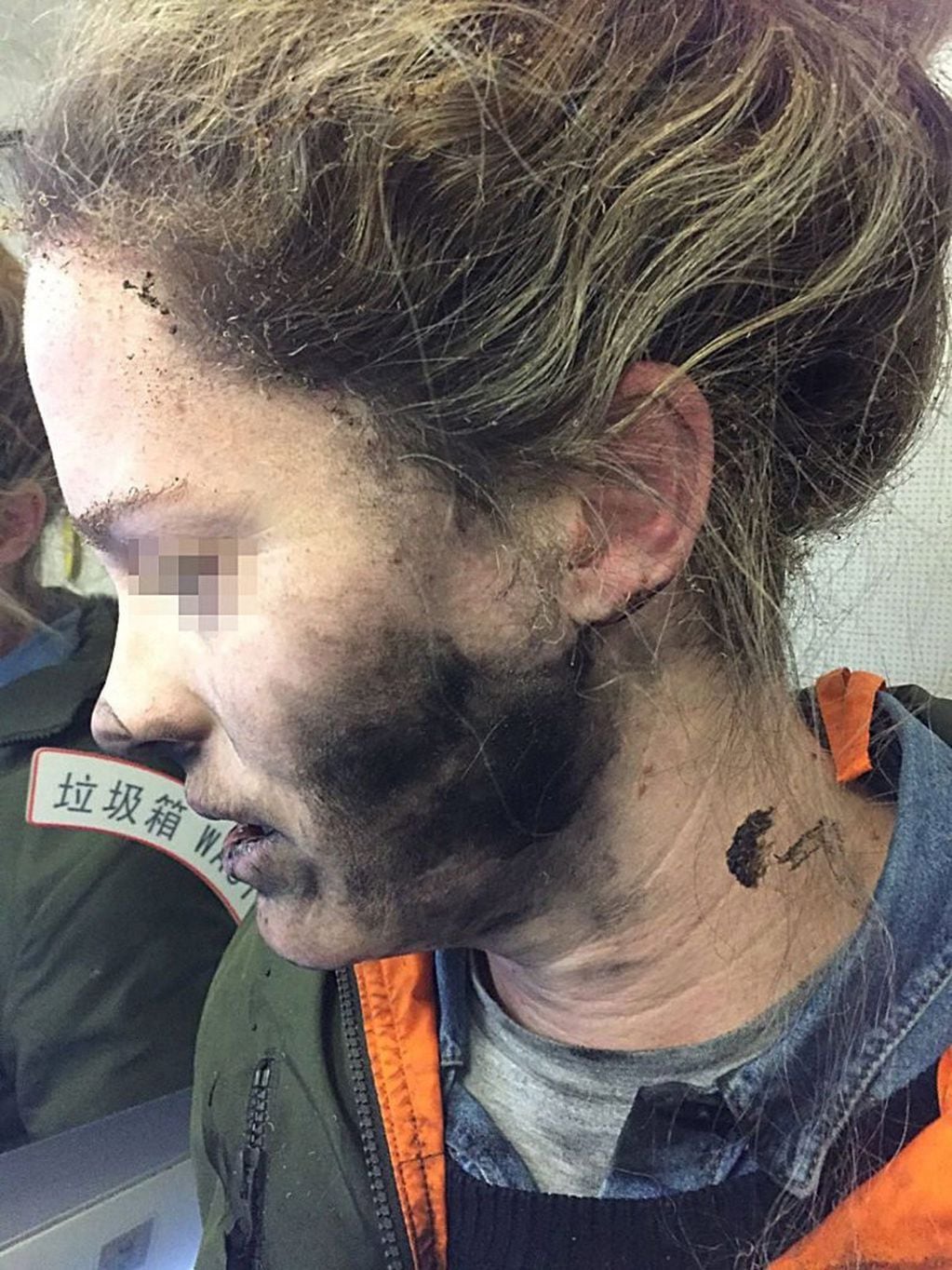 Una foto sin fecha de 2017: una mujer muestra las lesiones que sufrió cuando los auriculares que llevaba explotaron durante un vuelo desde Pekín a Melbourne. Crédito: EFE.