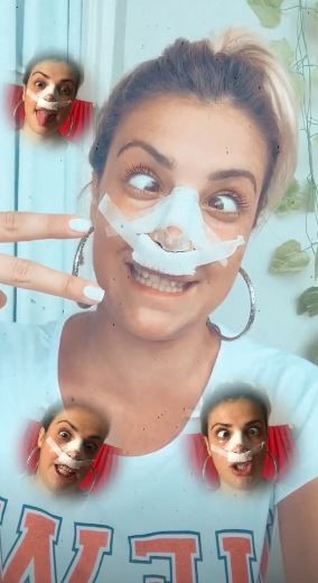 Bianca Iovenitti se operó la nariz y mostró cómo quedó su cara en Instagram (Foto: Instagram/ @bianiovenitti)