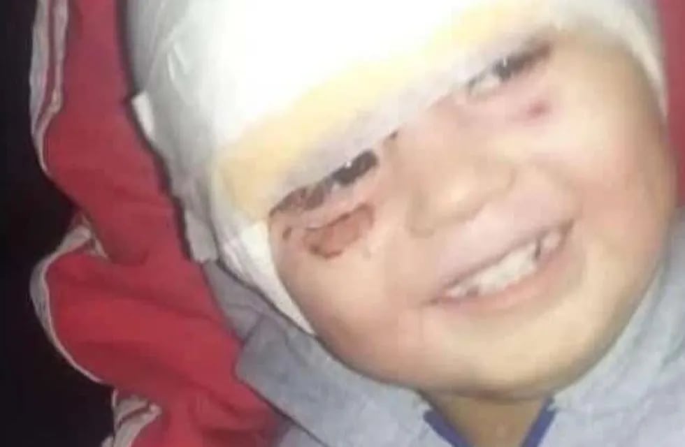 Él es Ángel Damián, el bebé sanjuanino que sufrió quemaduras con aceite hirviendo en su rostro.