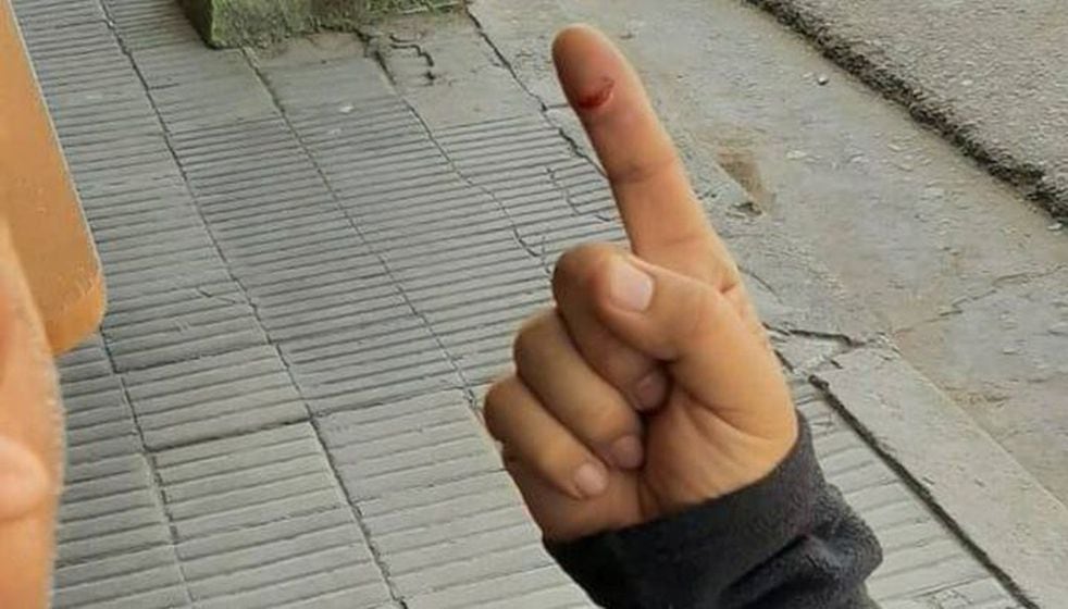 El médico mordió el dedo del dueño del hotel (Imagen ilustrativa).