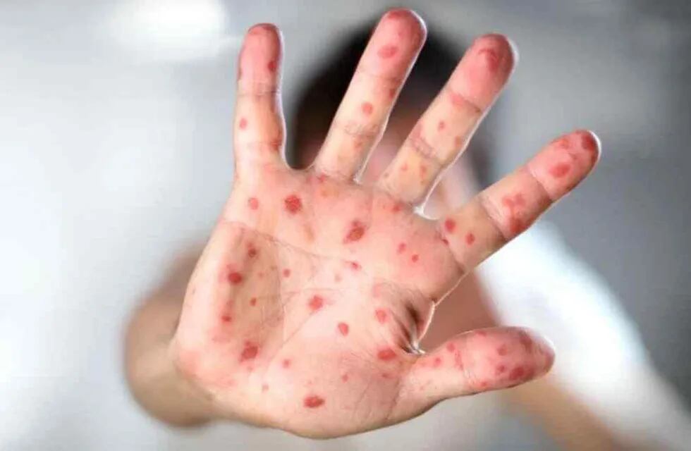 El Ministerio de Salud informó un "posible caso" de sarampión y emitió alerta epidemiológico