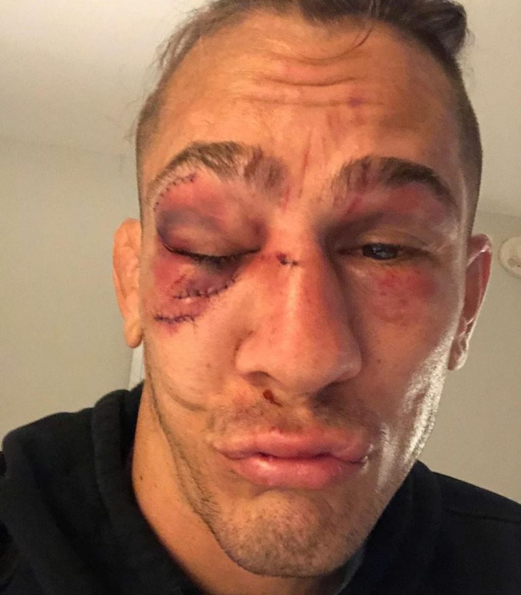 Así quedó el rostro del luchador de MMA Niko Price tras perder por nocaut técnico en la UFC (Foto: Instagram)