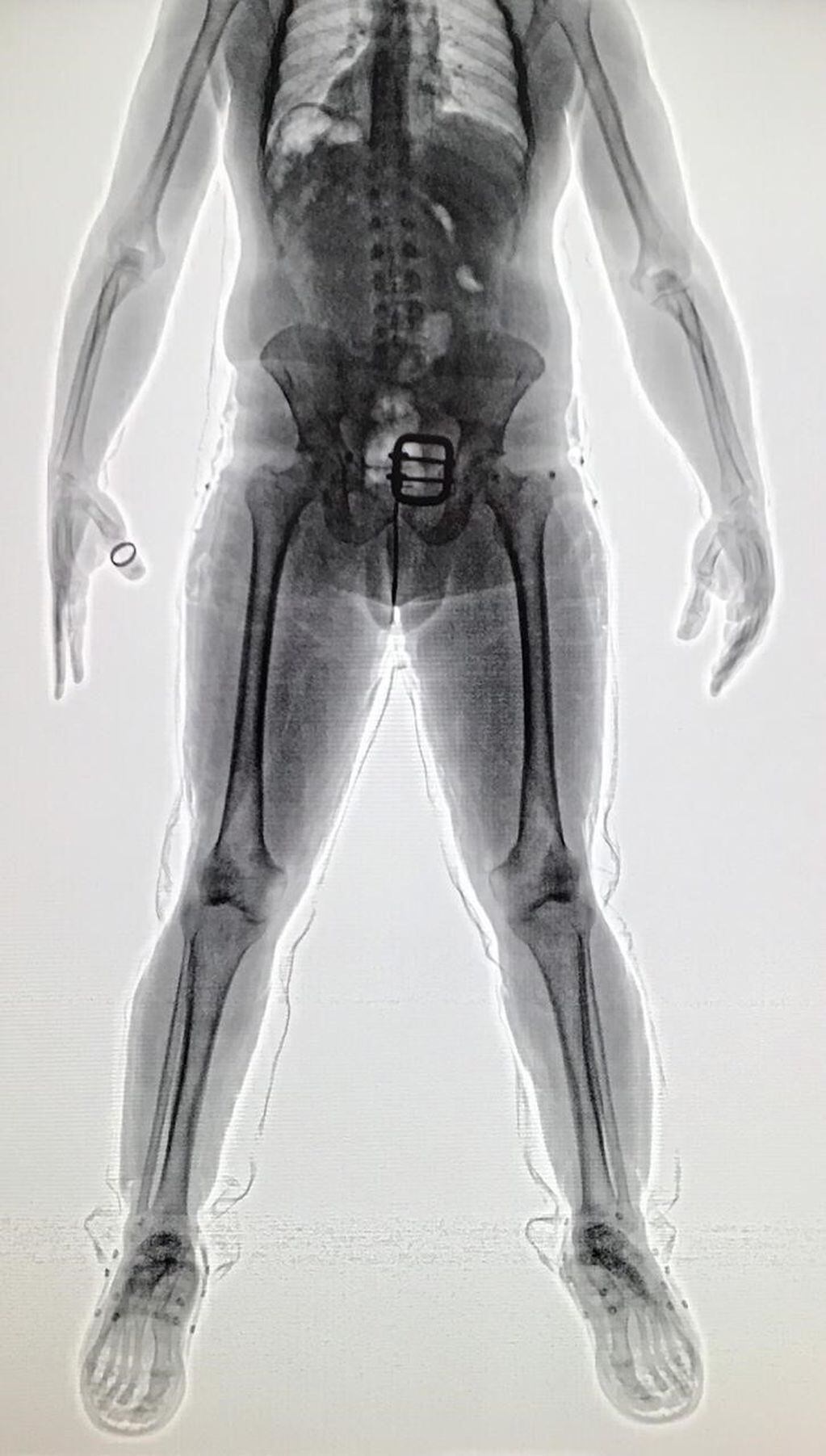 Escaneo del cuerpo del hombre que intentó viajar a Europa con droga oculta en vendajes de sus piernas. (Policía Federal de Brasil)